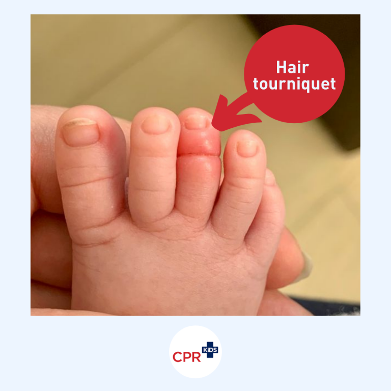Hair tourniquets...a risk to tiny toes (and other parts). CPR Kids
